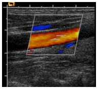 Farbcodierte Duplexsonographie
